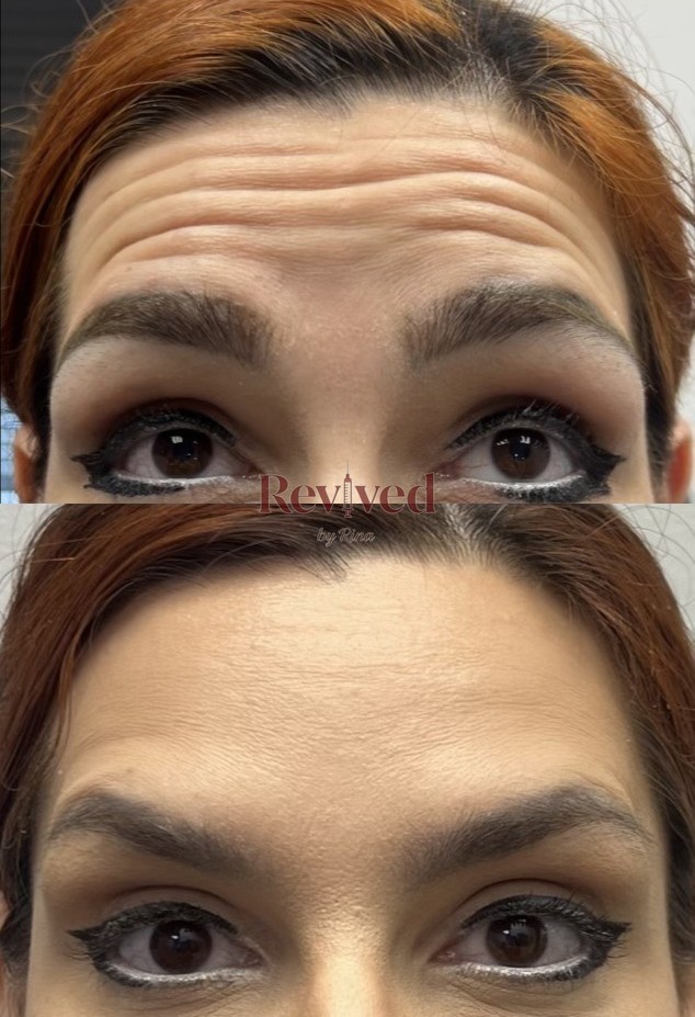 Xeomin before and after, forehead lines
