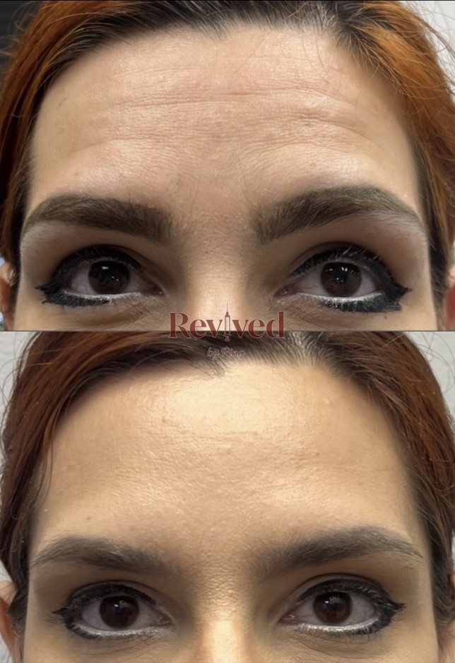 Xeomin before and after, forehead lines