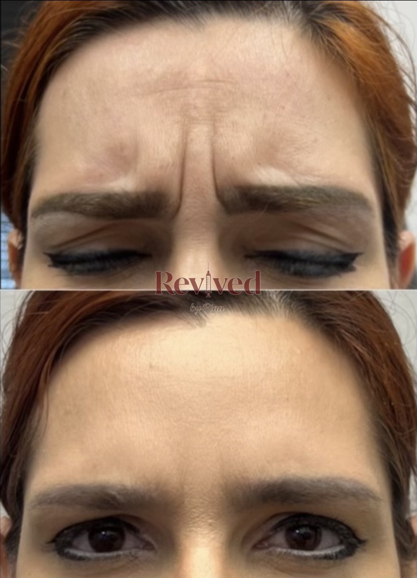 Xeomin before and after, frown lines