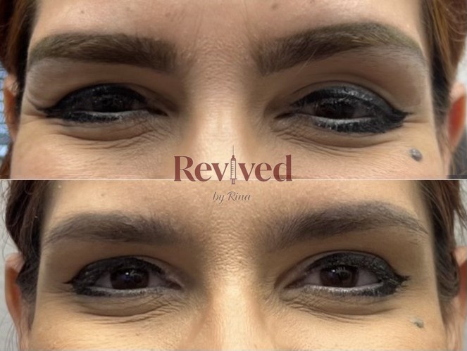 Xeomin before and after, crow's feet