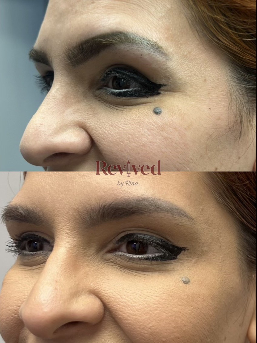 Xeomin before and after, crow's feet