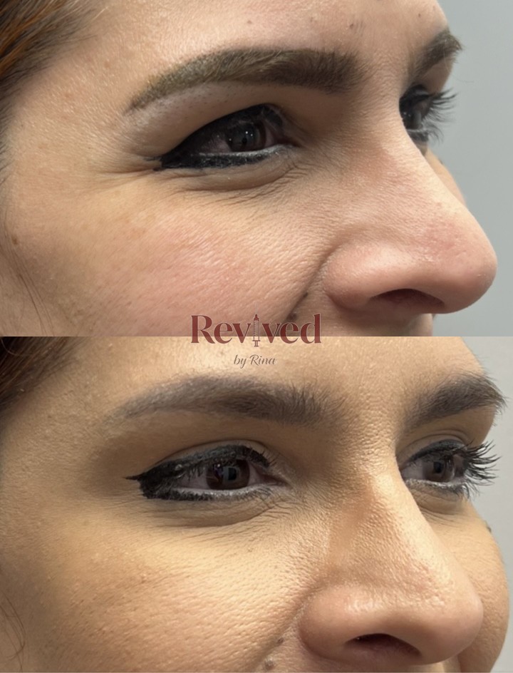 Xeomin before and after, crow's feet