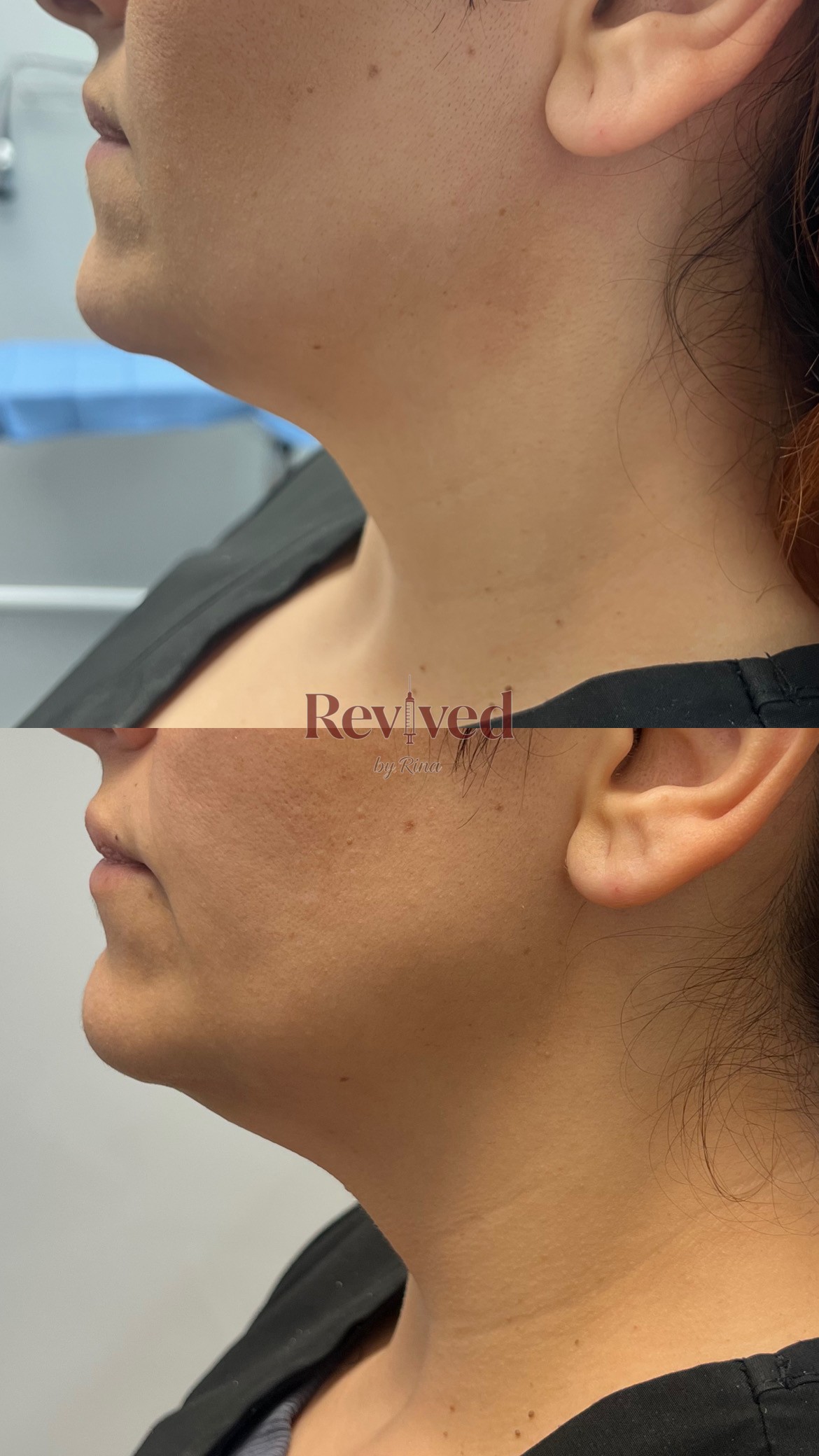 Xeomin before and after, jawline
