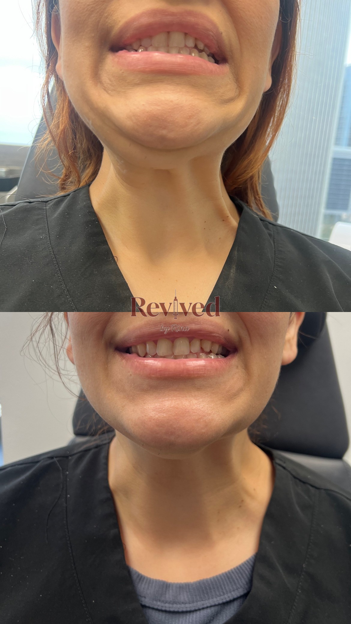 Xeomin before and after, jawline