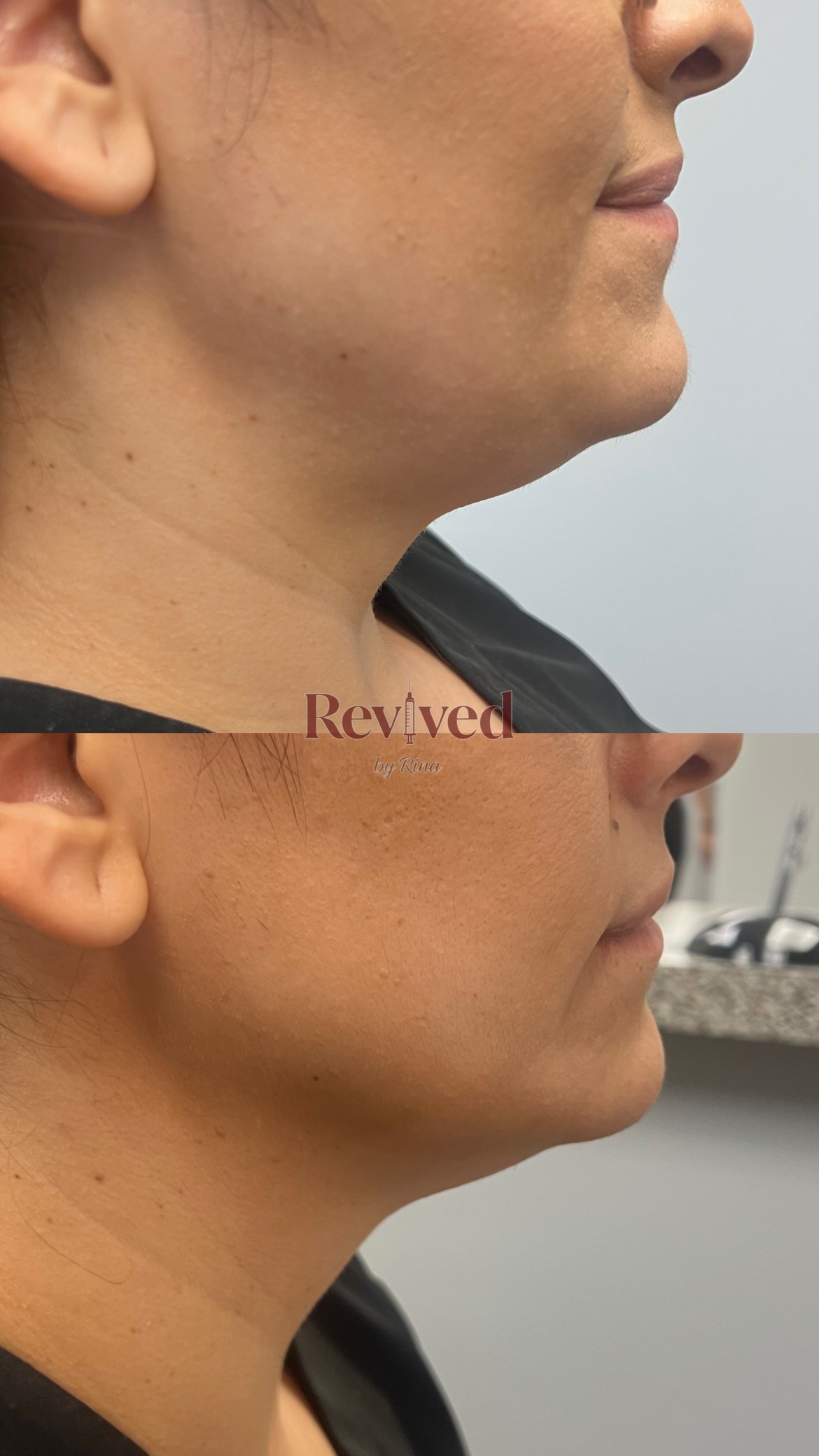 Xeomin before and after, jawline